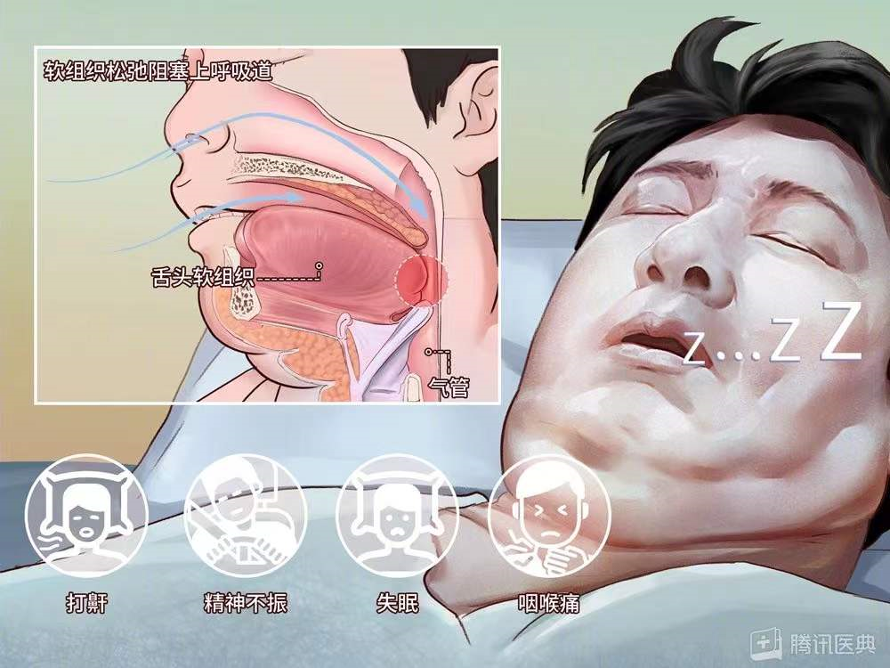 (图片来源:腾讯医典)(图片来源:腾讯医典)临床上及研究发现,长期打鼾