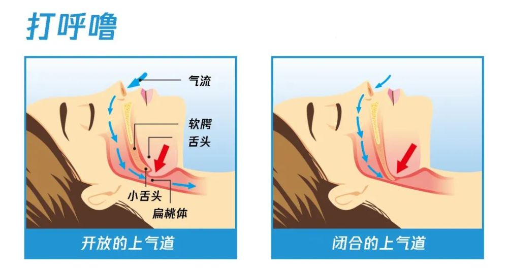 打呼嚕不是小毛病,2個辦法讓呼嚕