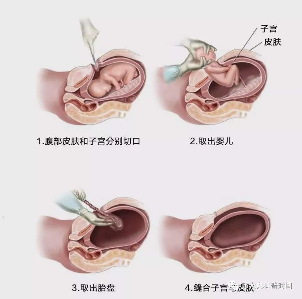 剖宫产手术要切几层要缝几层