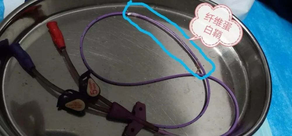 picc保管268天长出了什么看后让人震惊