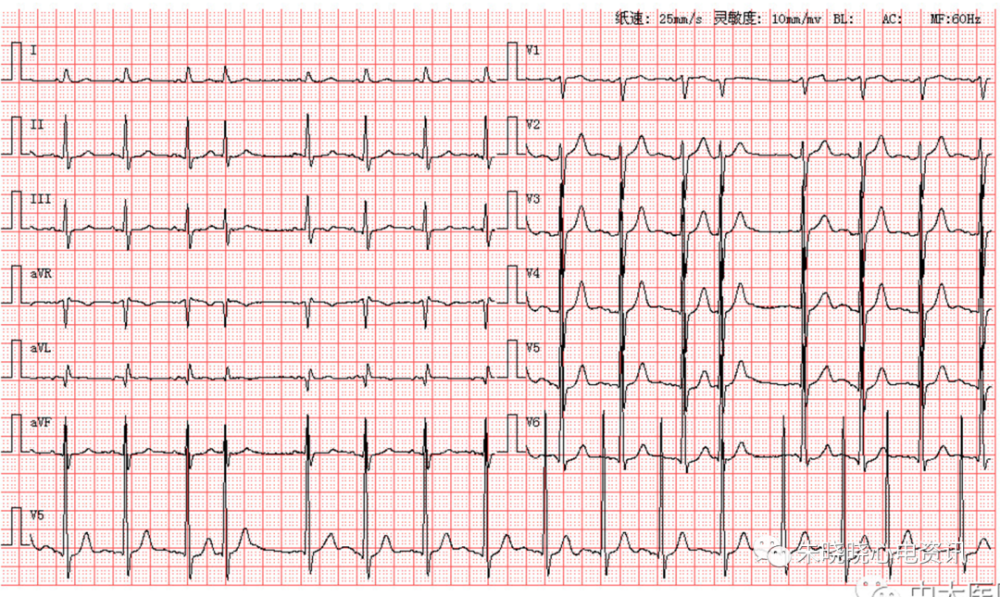 每日读图第1590期室早左前分支传导阻滞