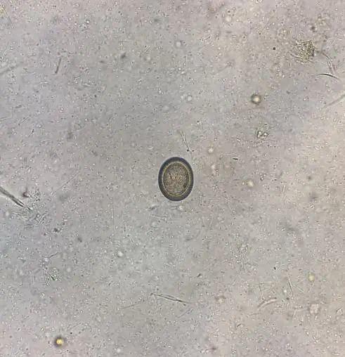 重口慎入,患者粪便里的超长带绦虫