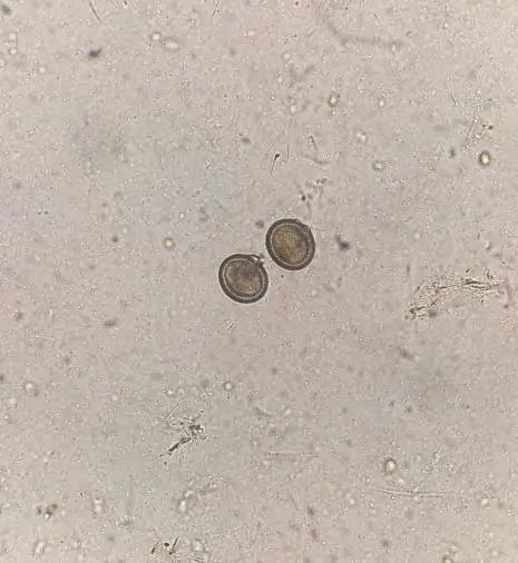 缘分就是在显微镜下多看了你一眼该例标本由于留取时间过久,导致孕节