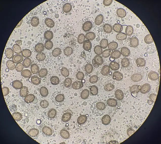 重口慎入,患者粪便里的超长带绦虫