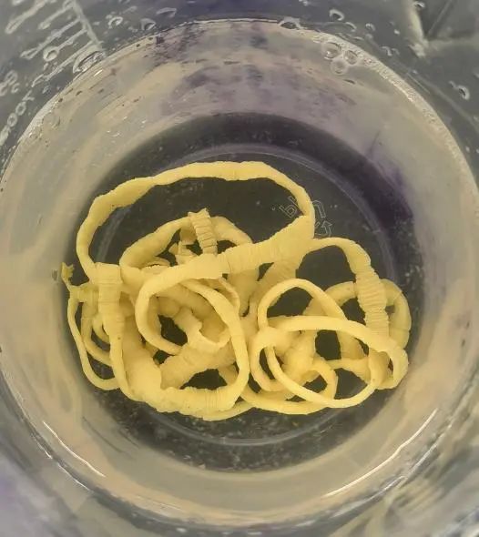 重口慎入,患者粪便里的超长带绦虫