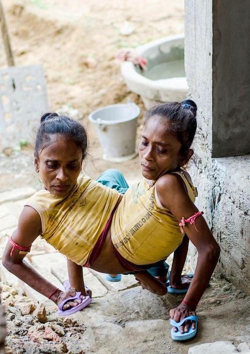 连体人的寿命不长?兄弟连体70年各自娶妻生子,专家保存下照片