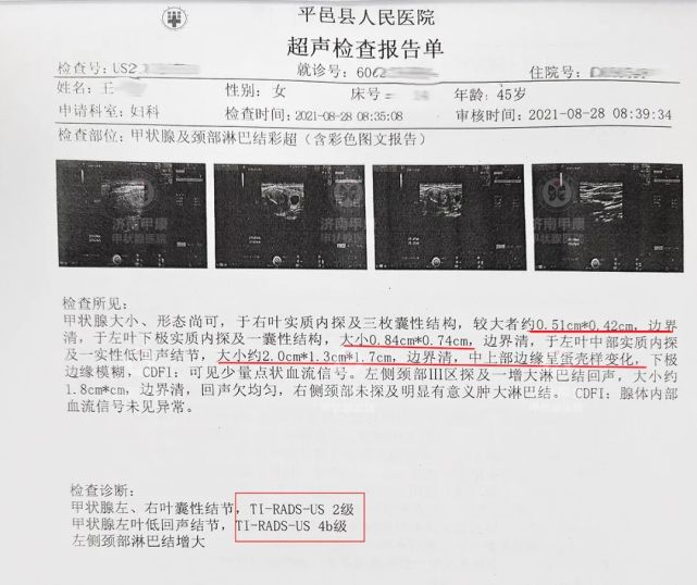 4b級結節病友擔心留疤和開刀後遺症來院微波消融治療重拾健康美麗人生