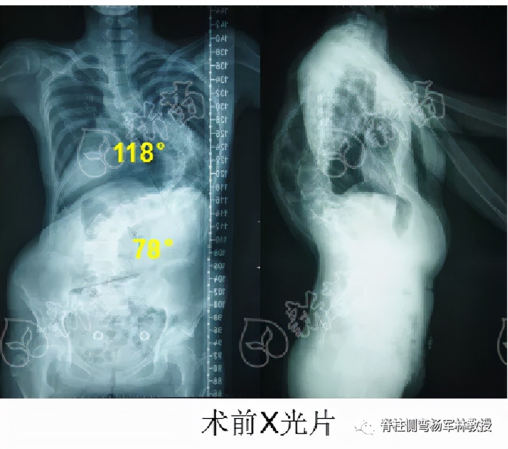 介紹到中山大學附屬第一醫院檢查,楊軍林教授再次確診為重度脊柱側彎