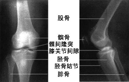 骨科精读|干货:髌骨骨折的核心技术要点,一文囊括!