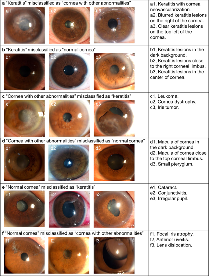 国内研发利用人工智能预防角膜炎导致的失明