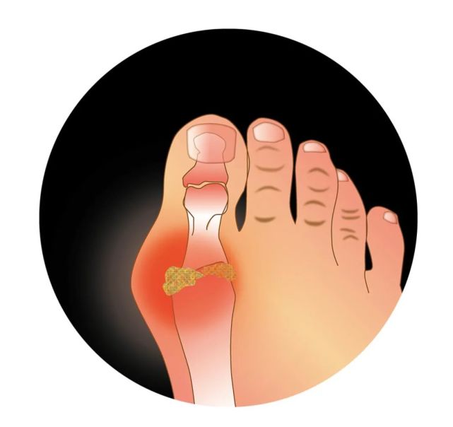 【家庭医生】大脚趾"痛"细寻因|膝关节|痛风|关节炎|脚趾