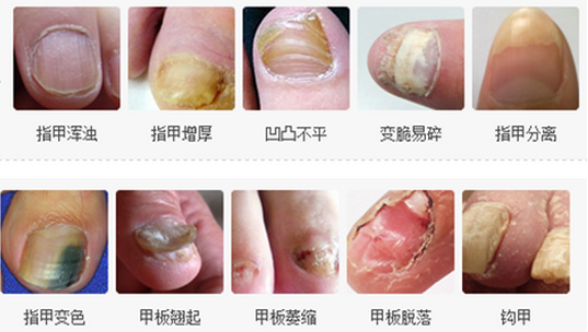 大家对于灰指甲这种常见的皮肤疾病肯定多多少少都有所了解,它在临床