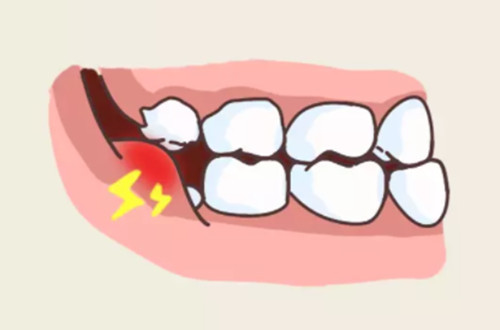 為什麼智齒會發炎腫痛呢智齒髮炎可以直接拔掉嗎