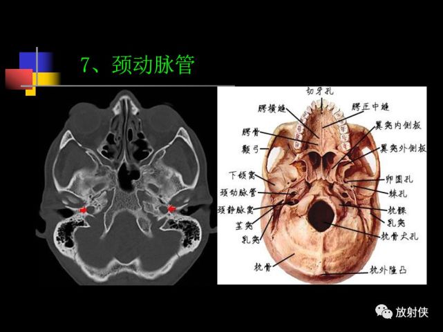 收藏必备|鼻咽部的ct详细解剖