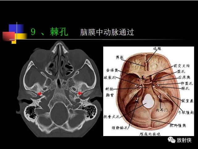 收藏必备|鼻咽部的ct详细解剖
