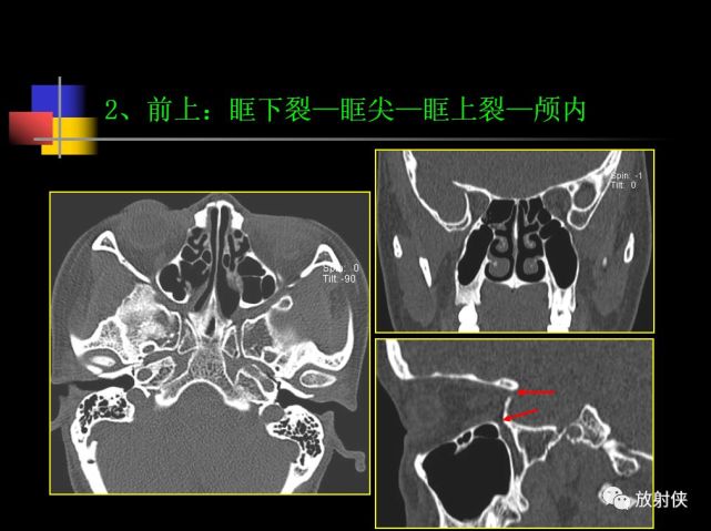 收藏必备|鼻咽部的ct详细解剖