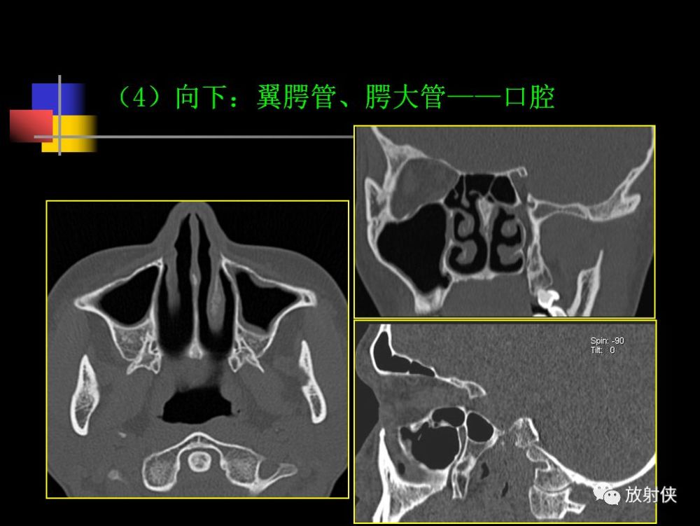 收藏必備鼻咽部的ct詳細解剖