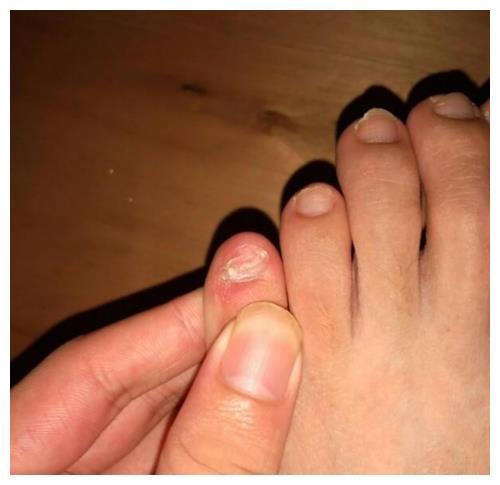 小脚趾甲分成两瓣的才是纯正的汉族人这种说法从何而来