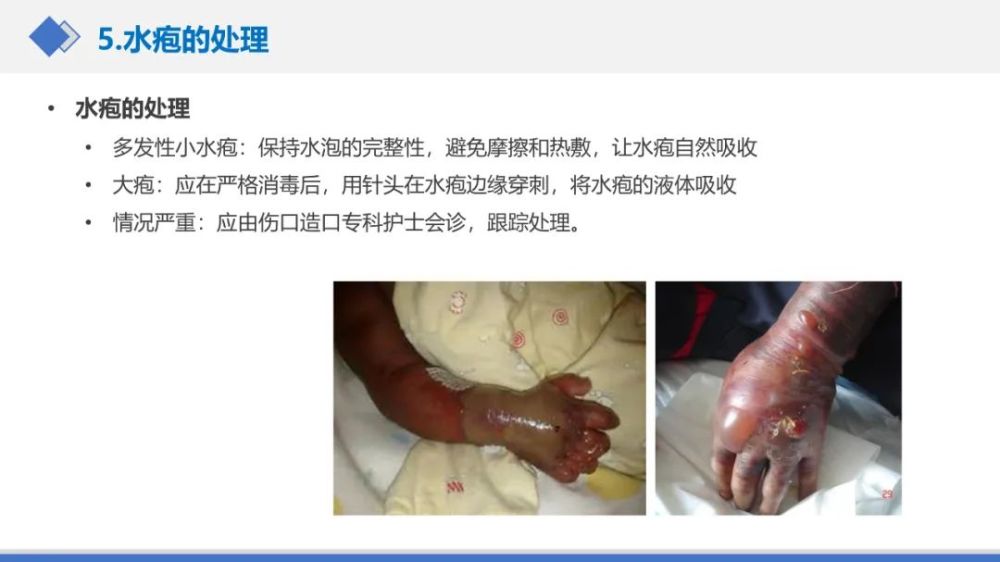 液体外渗的处理方法