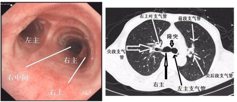 二,支氣管解剖圖:肺部分段ct圖如何進行肺部分段,肺部分段一般常用