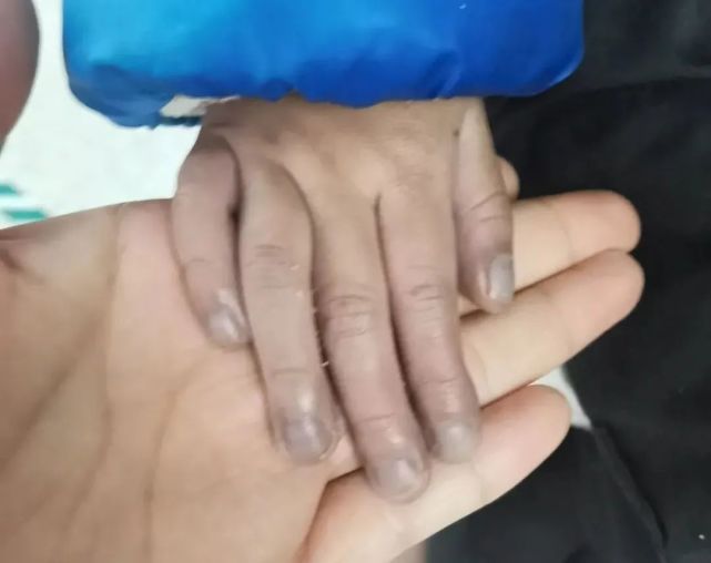 检查发现,亮亮患有罕见的心脏畸形,右心房室口的三尖瓣下移导致了血液