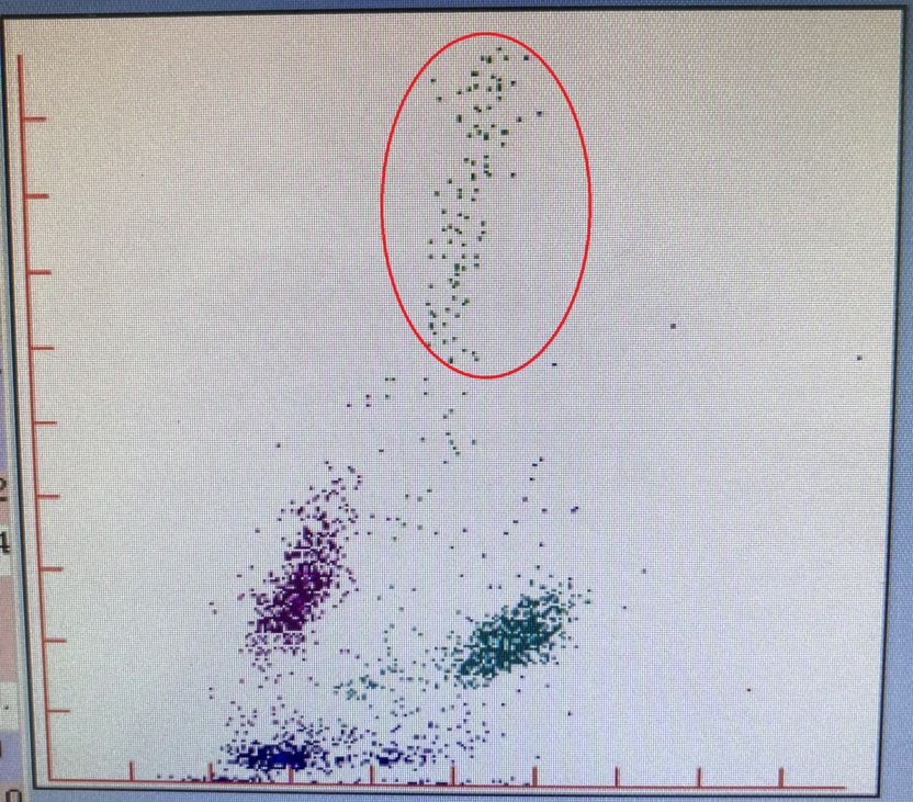 血常规及散点图:患者男性,68岁,诊断为肝恶性肿瘤【案例经过】全血