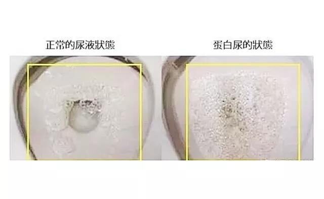 并且泡沫持续散不开的时候,就要考虑是否存在蛋白尿的可能