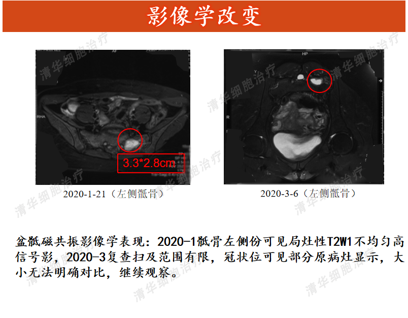 4 cea,ca19-9,cyfra21-1,ca125均處於正常範圍.ca72-4 2018.