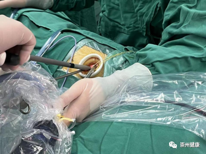 崇州成功实施首例应用定位针胸腔镜切除手术
