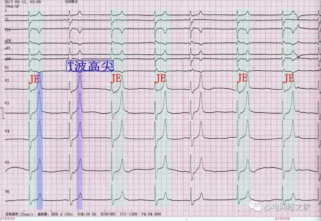 心電圖圖例分析28:高血鉀