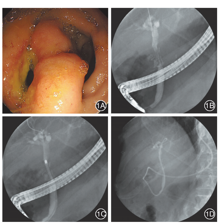 【202111病例】經內鏡逆行胰膽管造影診治肝移植術後膽總管十二指腸瘻
