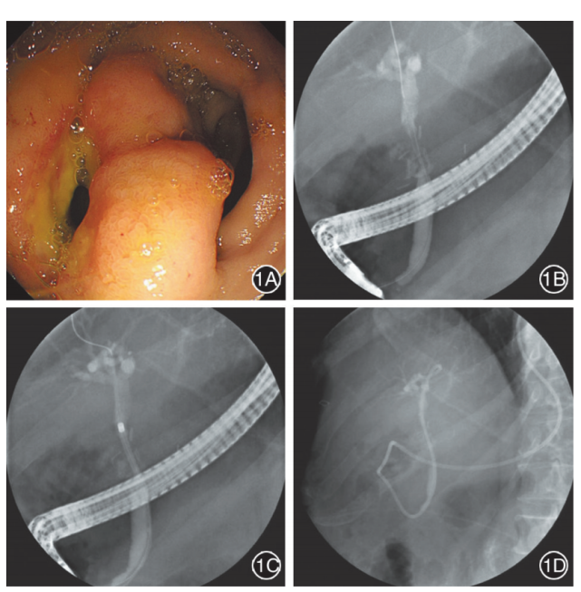 【202111病例】经内镜逆行胰胆管造影诊治肝移植术后胆总管十二指肠瘘
