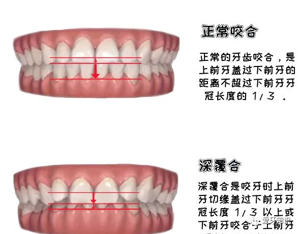 深覆合矫正后有哪些变化?