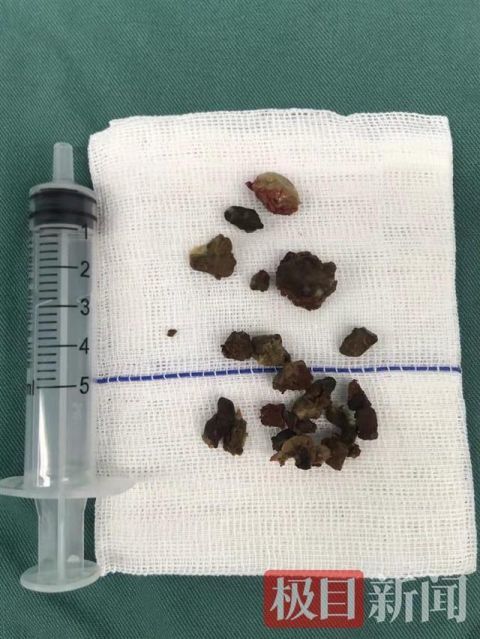一男子鼻子里竟然掏出石头医生这样说