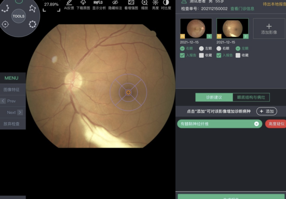 是全球首个通过人工智能对于眼底图像进行眼部多病种辅助诊断的临床