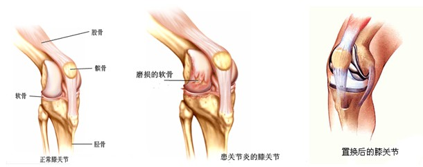 慈海醫療全膝關節置換術為高齡老人重拾行走的力量