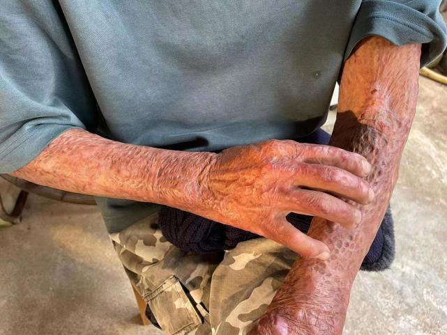 我被黑衣人泼汽油而烧伤的身体,留下了褐色疤痕.