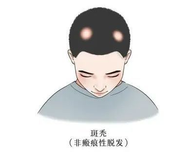 斑秃脱发试试这个膏方