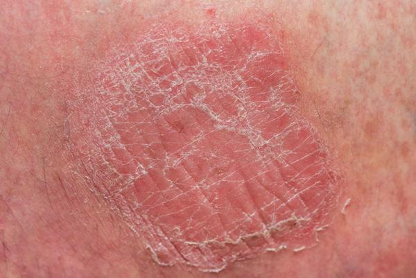 除此以外,大部分乳腺癌患者的乳房皮肤会出现一些橘皮样改变.