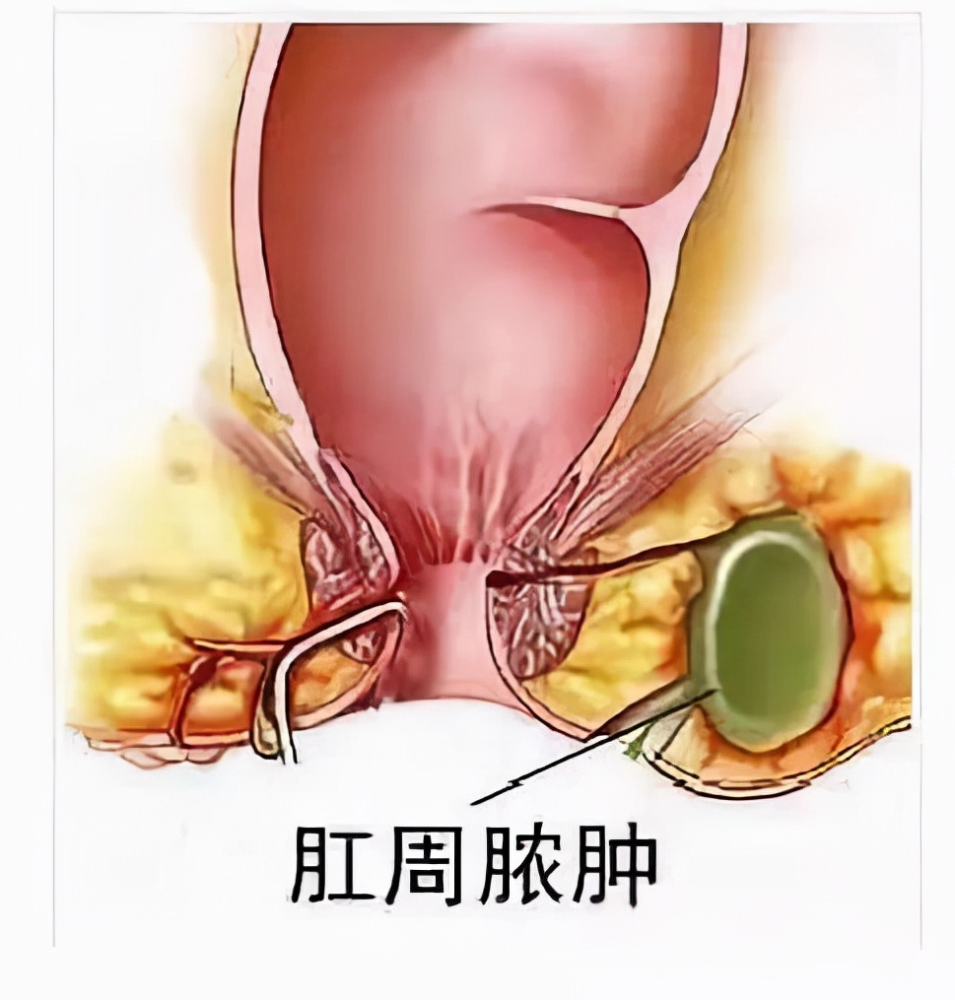 男子肛周脓肿罪魁祸首竟然是打麻将