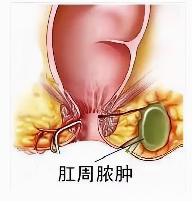 男子肛周膿腫罪魁禍首竟然是打麻將