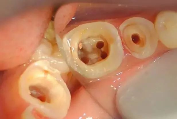 在牙根上打上桩钉,做个结实的核,让牙齿不易折断.