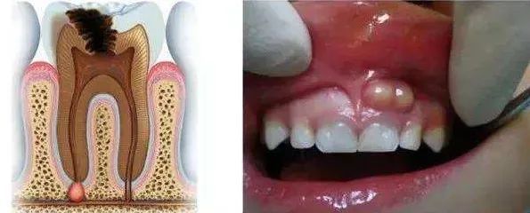 牙龈长脓包吃消炎药还是挑破千万别