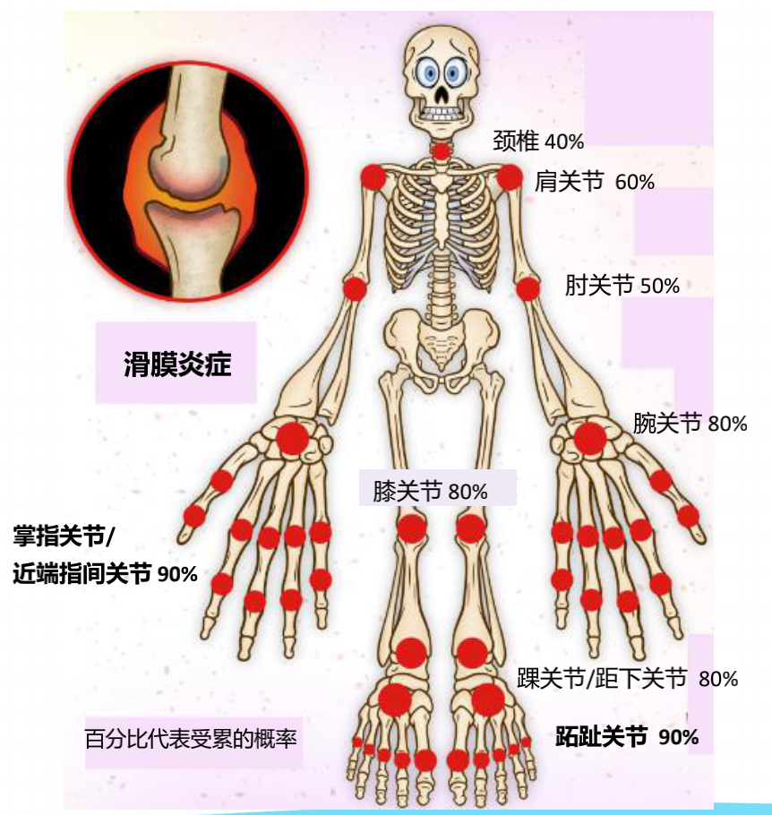 类风湿关节炎以四肢小关节最多见,3个或3个以上多关节受累,往往具有