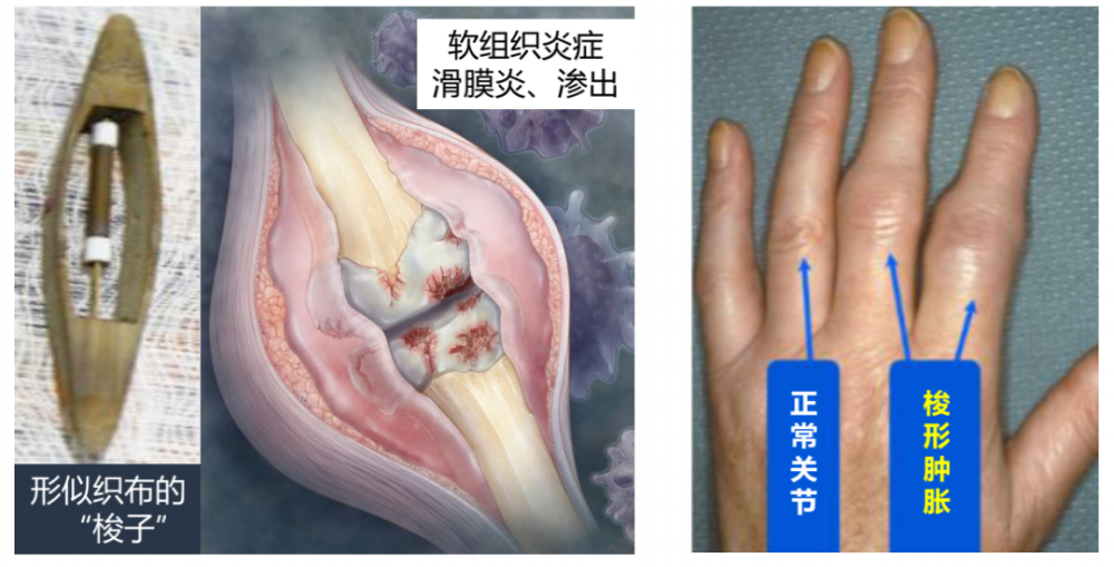 手指滑膜炎的症状图片