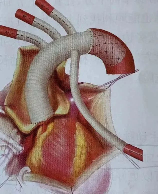公认的手术方式是换掉整个主动脉弓部,包括 bentall 手术后剩下的升主