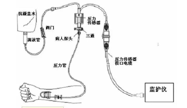 icu诊疗技术丨有创血压监测