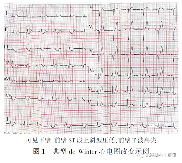 关于dewinter心电图改变的新认识