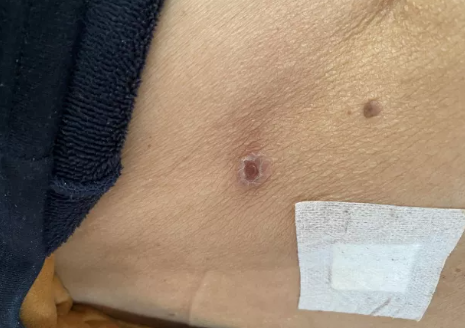 女子被神秘小虫咬伤高烧不退还长出奇怪的焦痂你可能也接触过