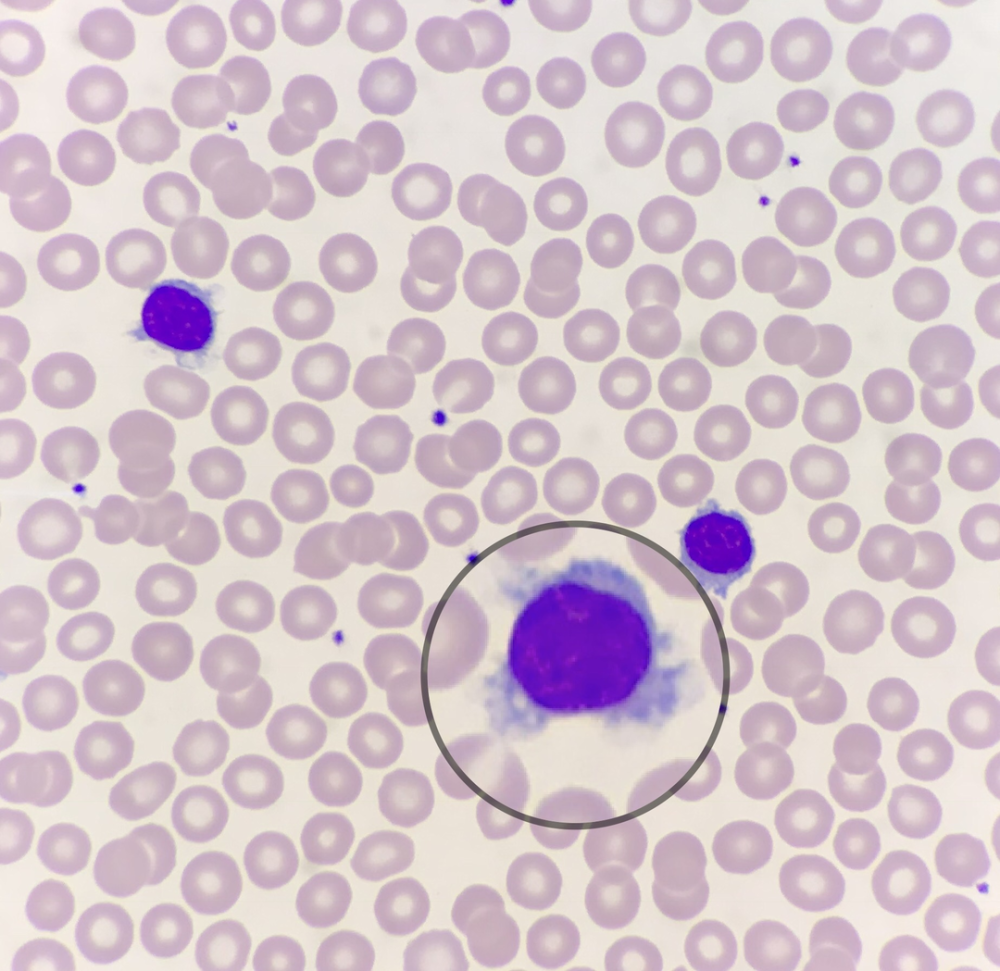 一例由外周血涂片辨识出的毛白